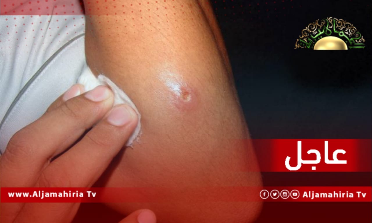 عاجل| ارتفاع عدد المصابين باللشمانيا في بني وليد إلى 675 حالة حتى الآن