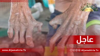 حالة مصابة بالجذام