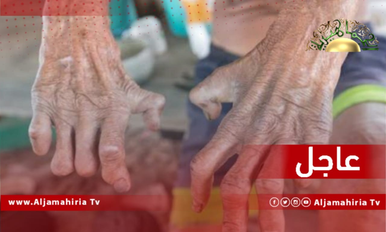 حالة مصابة بالجذام