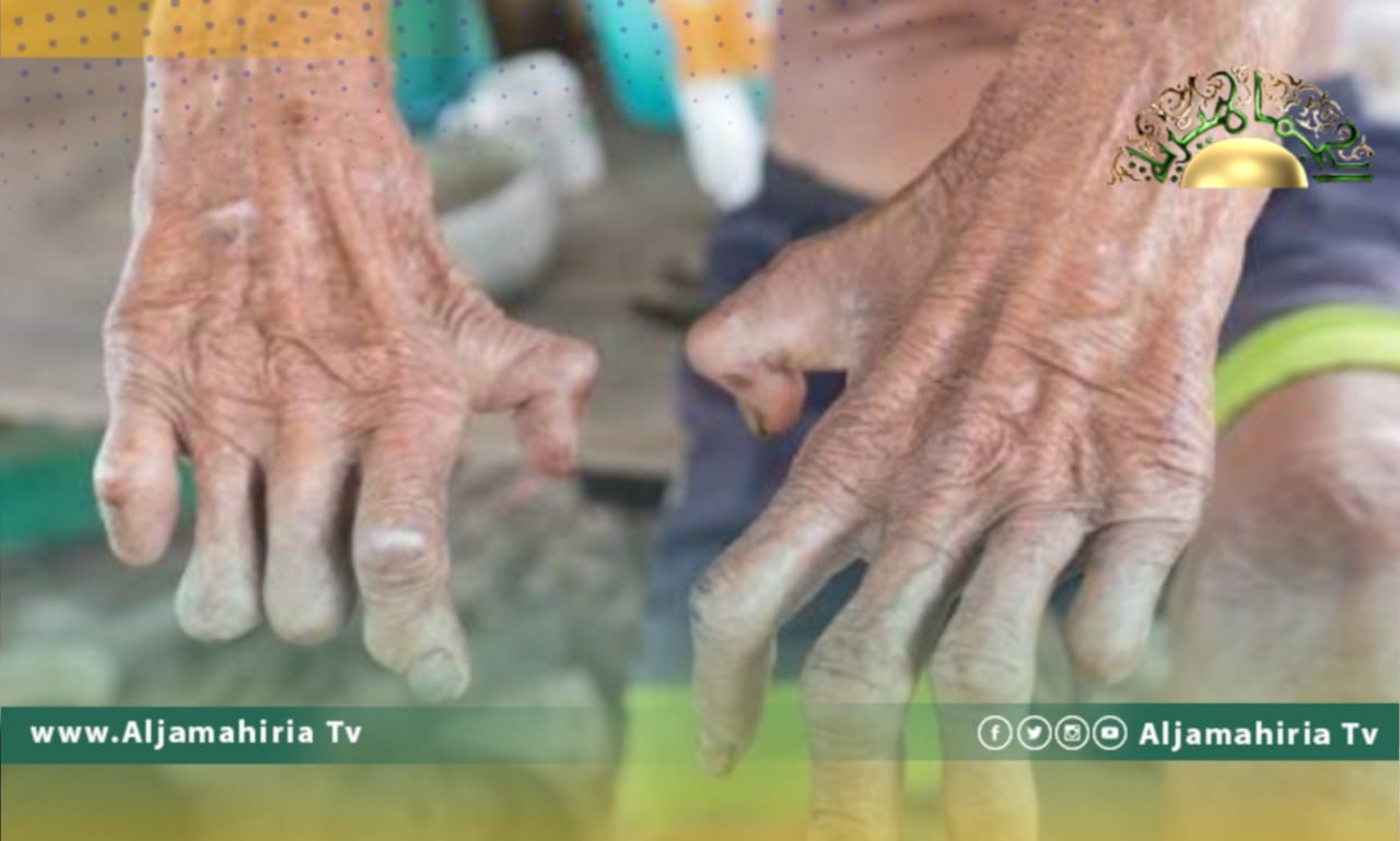 مصادر تكشف إصابة حالة بمرض الجذام في منطقة بئر الاسطى ميلاد