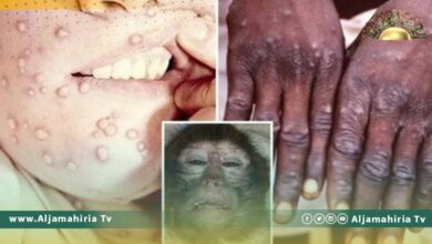 مفاجأة مطمئنة: الحاصلون على لقاح جدري البشر محصنون من جدري القرود بنسبة 85%