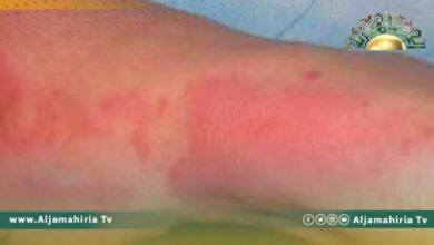 تعرض مواطن لحروق جراء انفجار مولد كهرباء في منزل بالمنصورة