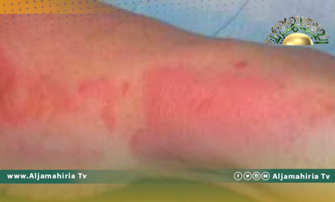 تعرض مواطن لحروق جراء انفجار مولد كهرباء في منزل بالمنصورة