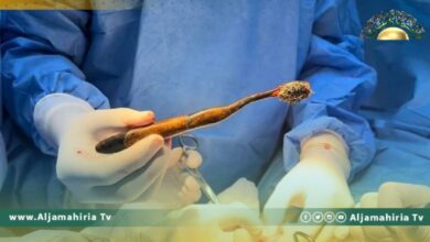 في عملية جراحية.. العثور على فرشاة أسنان في معدة سيدة
