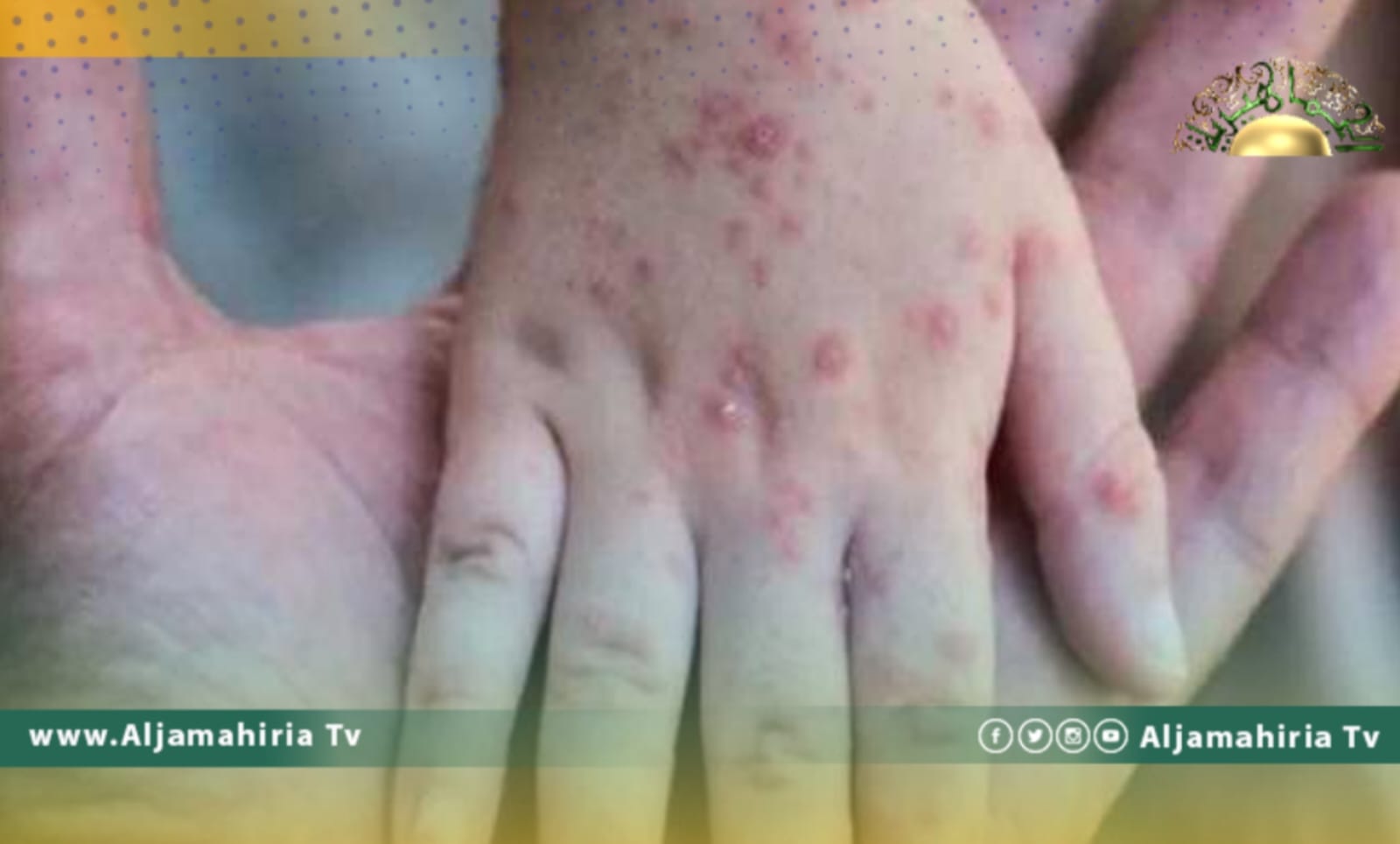 السائح يؤكد عدم توفر لقاحات ضد جدري القرود في ليبيا