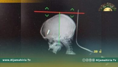 نتيجة الاحتفال بالنجاح.. مقتل طفلة متأثرة بإصابتها برصاصة طائشة