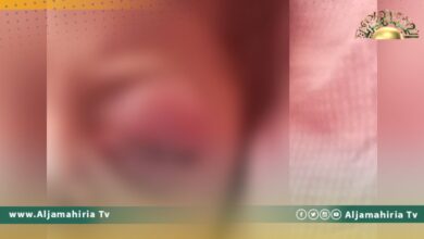 مصادر طبيبة: ظهور حالات التهابات بمستشفي العيون في طرابلس بسبب التلوث